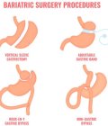 Bariatric Surgery in Türkiye | MPGCARE