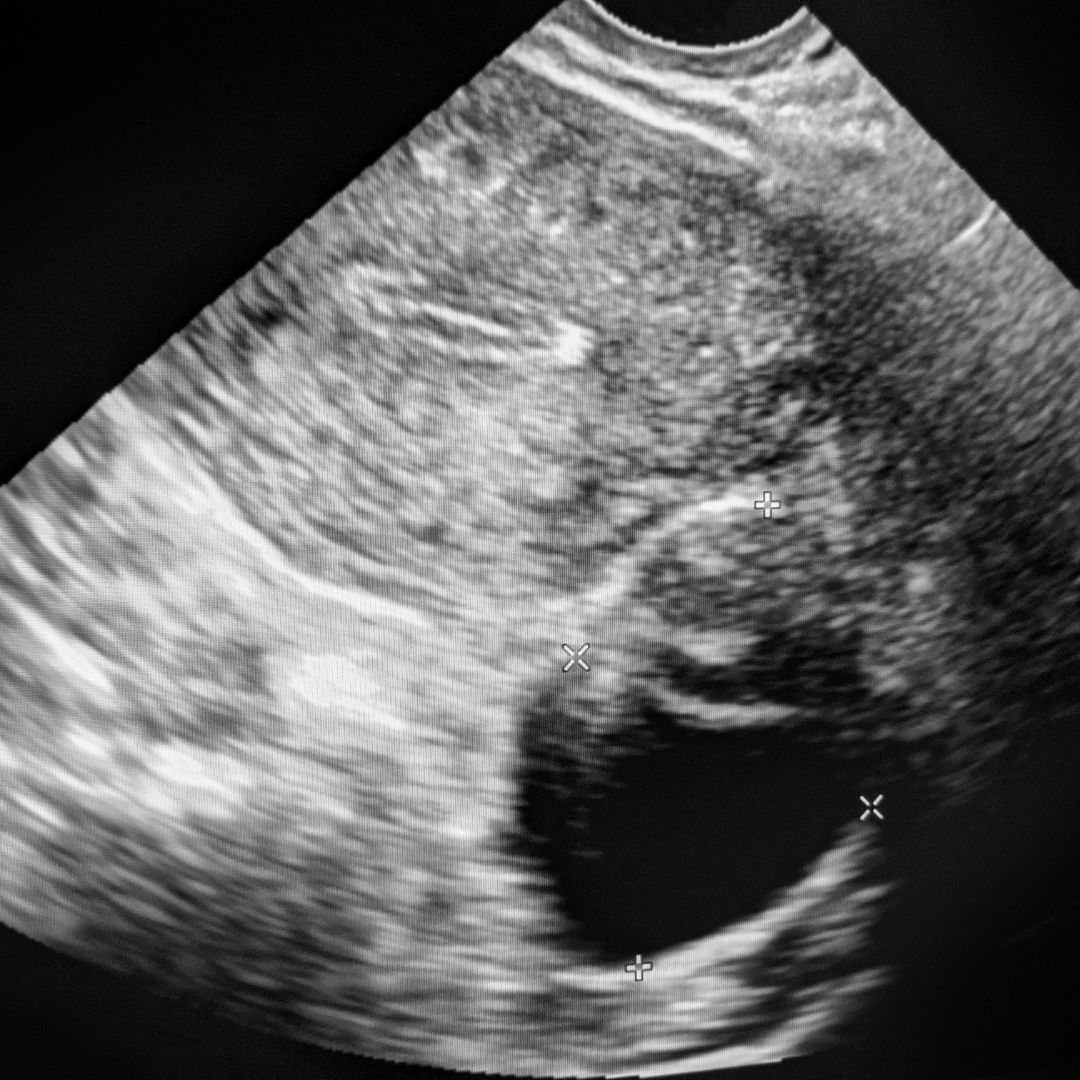 MPGCare Medical Park Meme Kisti Görüntüleri ve Ultrason